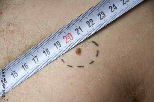 melanoma with hairs on Caucasian man skin with meter