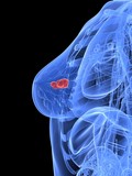 weibliche Brust mit Tumor