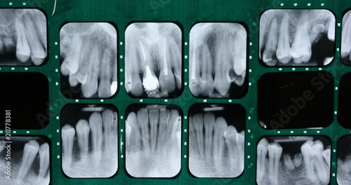 Dental X-ray