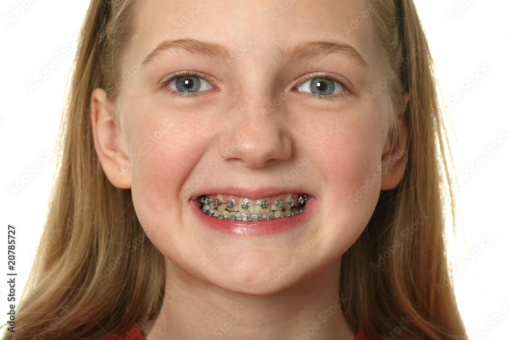 Dental Braces Dental Braces