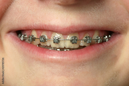 Dental Braces