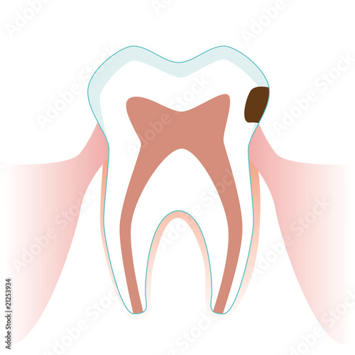 dent pourri