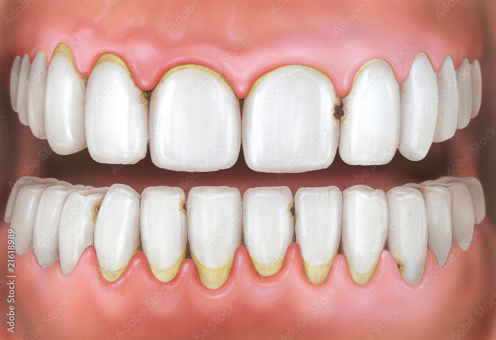 Obraz premium Gebiss mit Karies