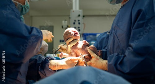Baby being born via Caesarean Section photo