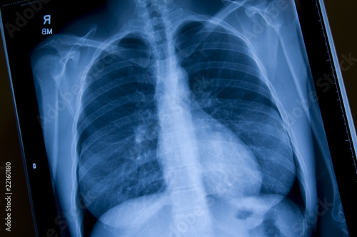 X-ray of Chest