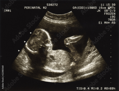 Canvas Print Ultrasound of a fetus at 20 weeks