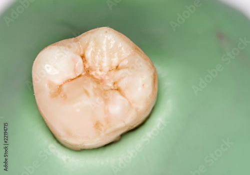 Tooth, caries