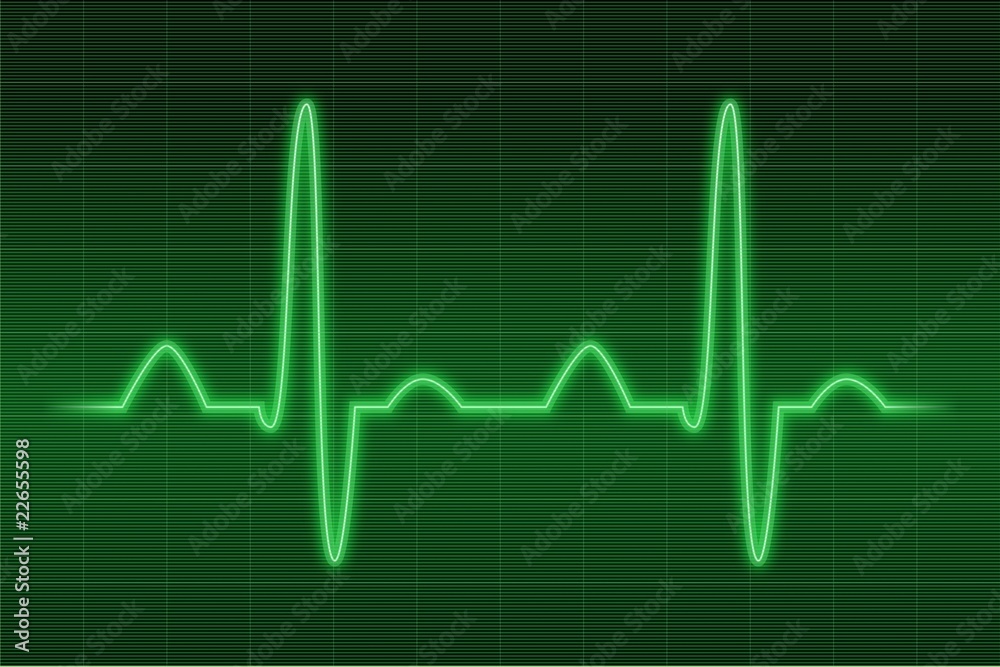 EKG IV EKG IV