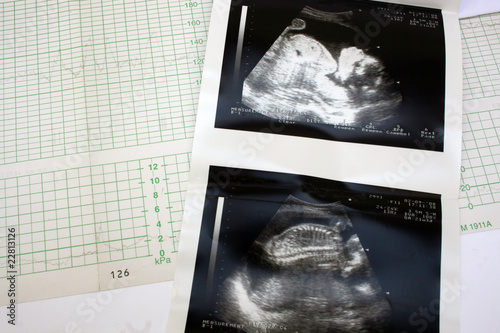 cardiograph and ultrasound