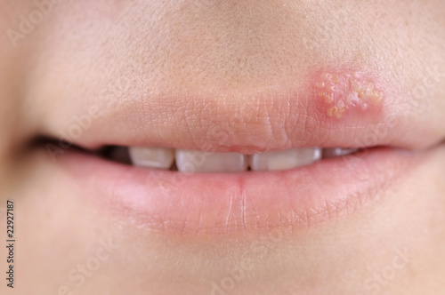 Close up of lips affected by herpes. photo