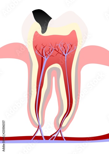 Tooth decay