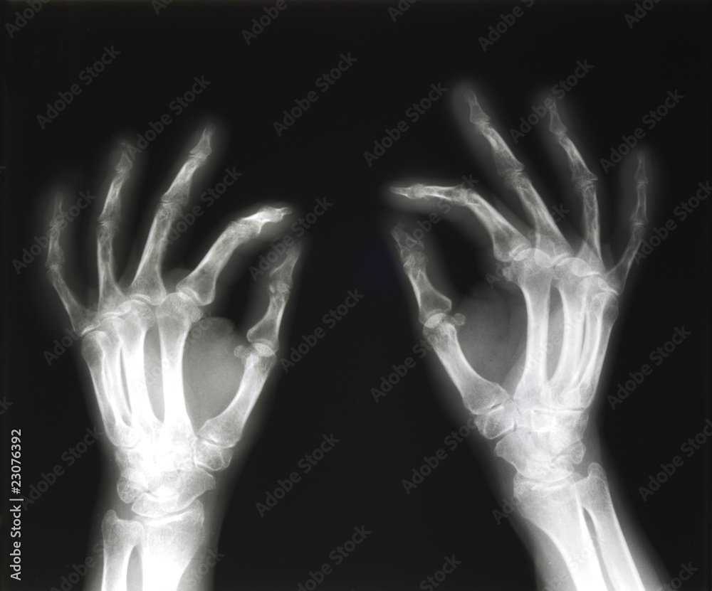 X-ray of hands pinching X-ray of hands pinching