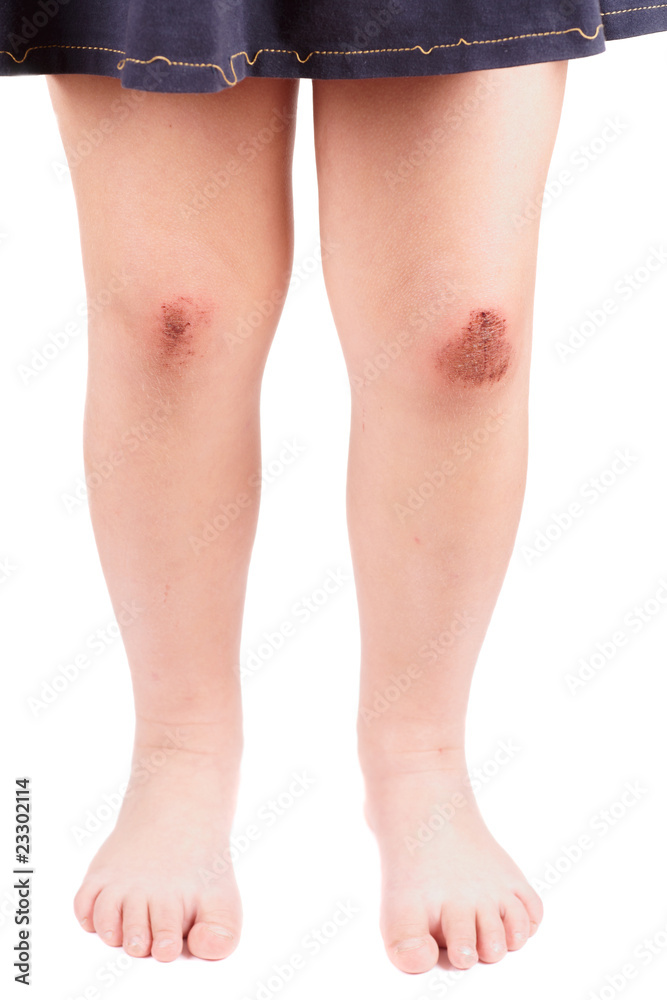 Scraped knees of a little girl