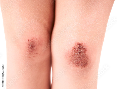Scraped knees of a little girl