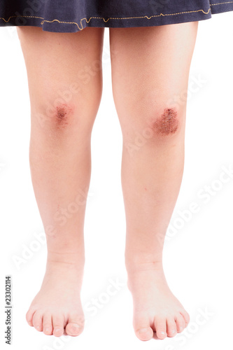 Scraped knees of a little girl © Kondor83