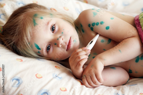 Girl suffers chickenpox