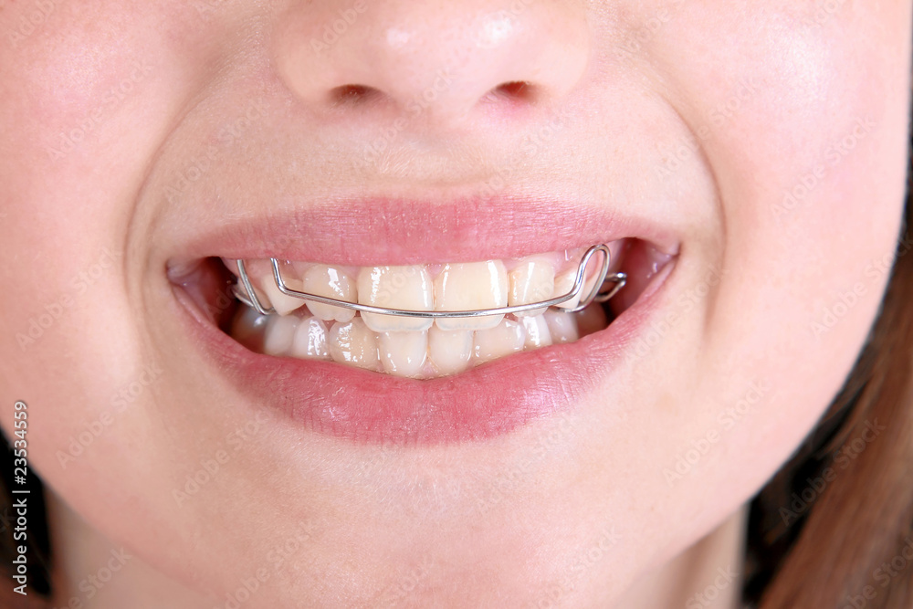 Zahnspange Stock Photo | Adobe Stock