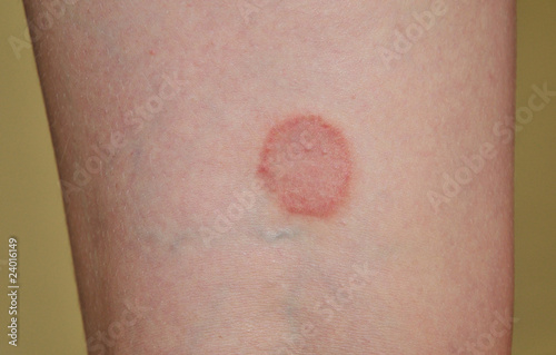 lichen ruber planus