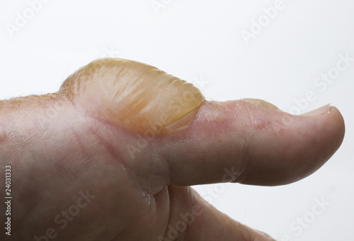 Quadro em tela huge water blister on a thumb after getting into poison ivy or poison oak while