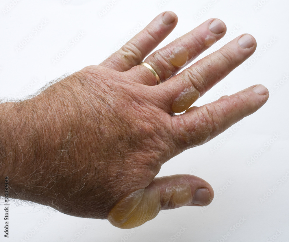 Poison ivy attack showing with a swollen hand covered in painful