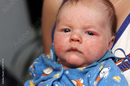 Baby with allergic diathesis photo