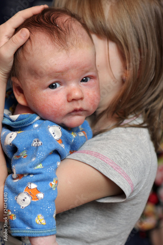 Baby with eczema on face