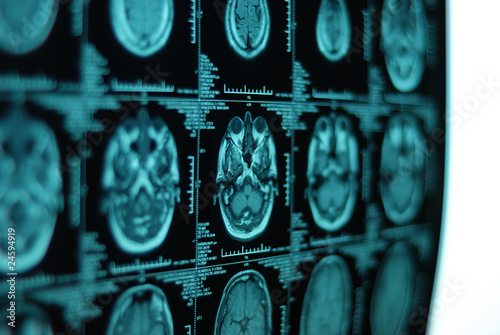 MRI scan of human brain photo