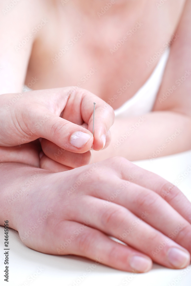 Acupuncture Acupuncture