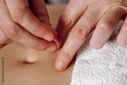 Acupuncture hands