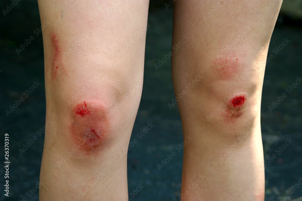 Skinned Knees Stock Photo Adobe Stock