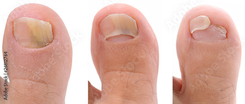 A sequence of a toe nail suffering from fungus infection. photo
