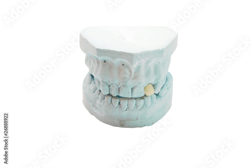 gypsum model of human teeth