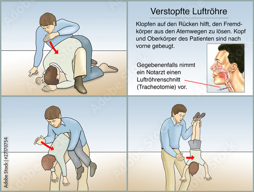 Fotografi Erstickungsanfaellen, verstopfte Luftroehre, Fremdkoerper im Mun