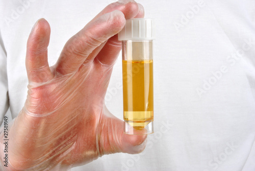 eine Urinprobe in einer Probenflasche photo
