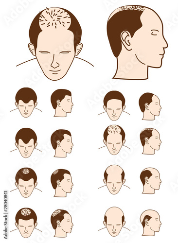 hair loss