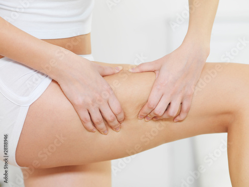Female squeezes cellulite skin on her legs