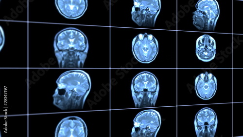 MRI brain scan