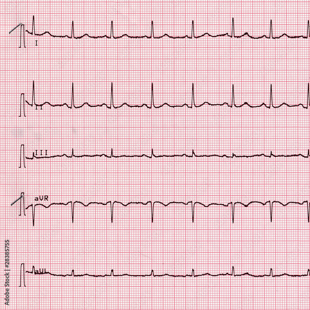 Electrocardiography of heart beat Electrocardiography of heart beat
