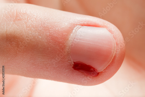Photos Blood wound finger nail