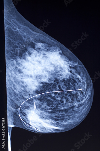 Mammogram - Needle Localization