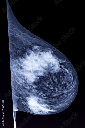 mammogram