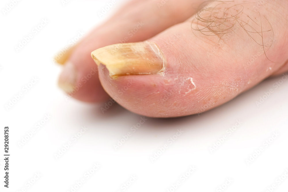 Say Goodbye To Fungal Toenails! Discover The Causes, Treatments, And  Prevention Methods - YouTube