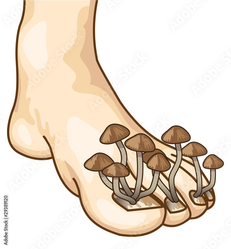 Onychomycosis.