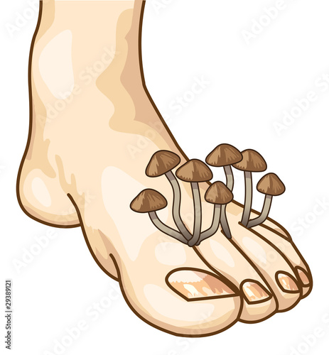 Mycosis between the toes.
