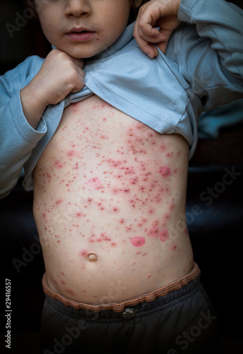 varicelle bouton contagieux maladie enfant contagion démangeais
