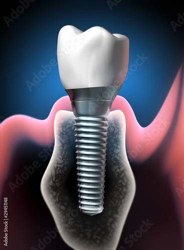 Zahnimplantat Detail 1