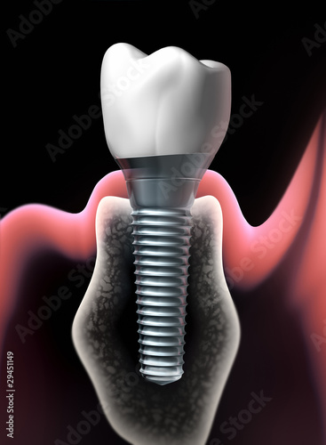 Zahnimplantat Detail 2