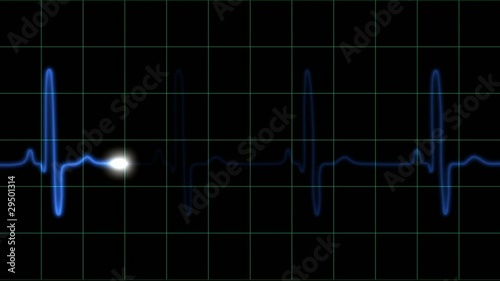 EKG