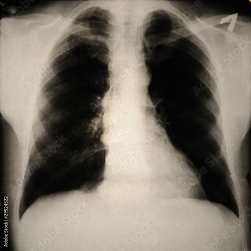 human chest with Forestier's disease on x-ray