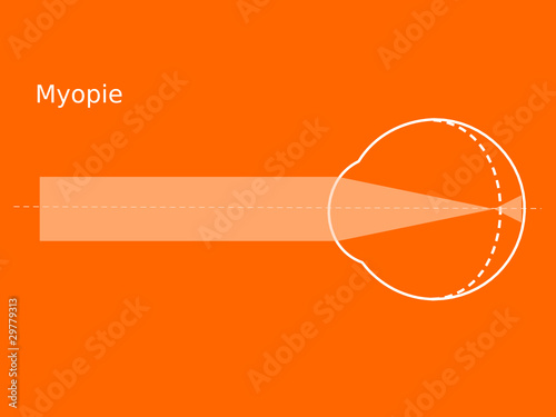 Schema Myopie